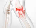 Osteoarthritis is usually the result of chronic cartilage damage. However, cartilage is only a small part of the complex knee system.