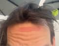 Est-ce à cause du casque ou de la lampe frontale ? Dans tous les cas, c'est agaçant. J'ai une marque de pression sur le front.