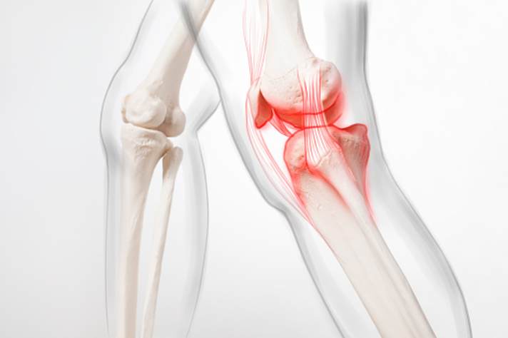 Eine Arthrose ist in der Regel die Folge eines chronischen Knorpelschadens. Der Knorpel ist jedoch nur ein kleiner Teil des komplexen Systems Knie.  Foto: Filip Krstic