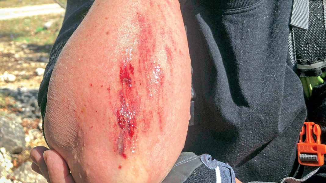 Tückische Schrammen: Erste Hilfe bei einer Schürfwunde