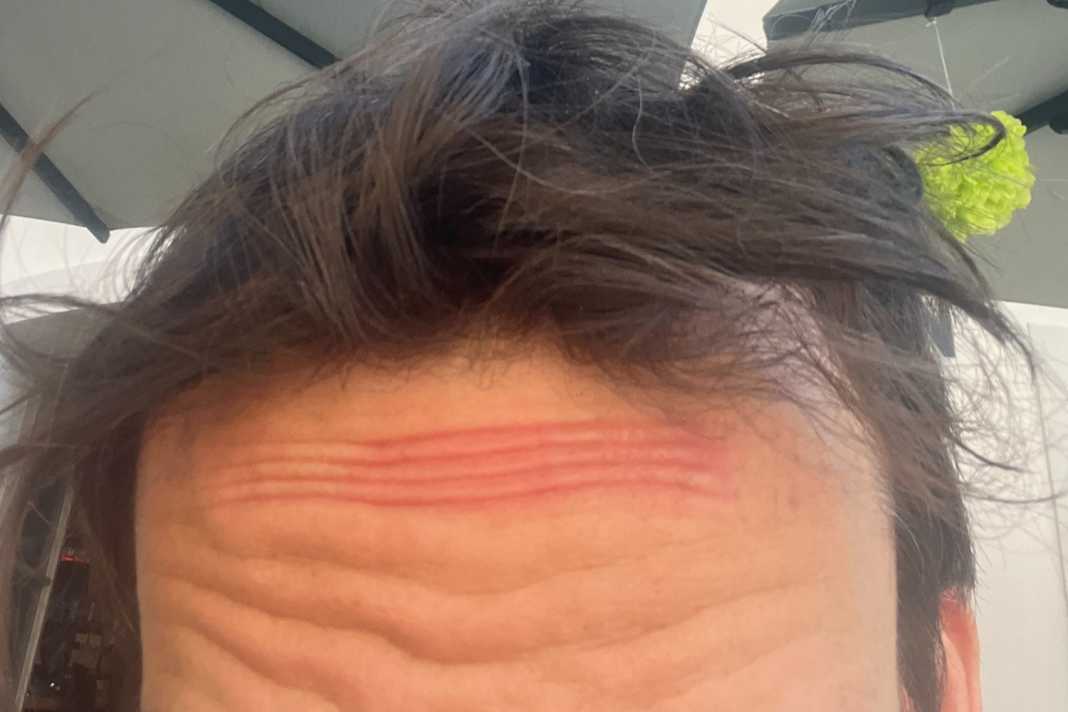 Liegts am Helm oder an der Birne? Nervig ist es so oder so. Druckstelle an der Stirn.