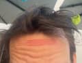 Liegts am Helm oder an der Birne? Nervig ist es so oder so. Druckstelle an der Stirn.