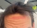 Liegts am Helm oder an der Birne? Nervig ist es so oder so. Druckstelle an der Stirn.